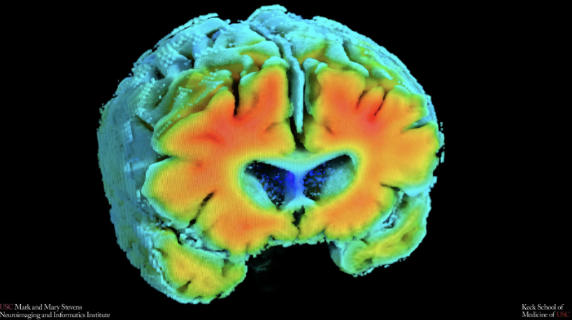 Wie Angst, Zellschutz und Durchblutung Alzheimer beeinflussen